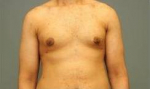 MALE CHEST CONTOURING / GYNECOMASTIA: Case 31 After